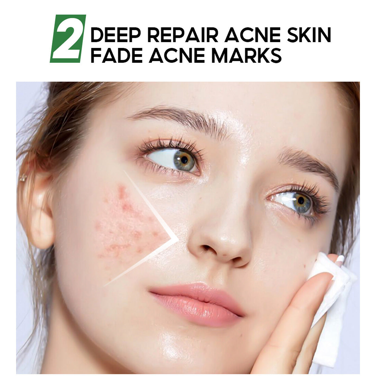 VIBRANT GLAMOUR FDA Herbal Acne Treatment Mask